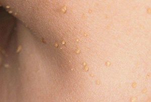 Skin Tags